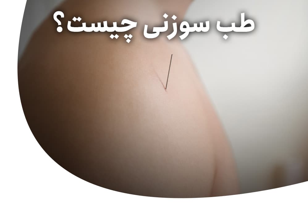 طب سوزنی چیست؟