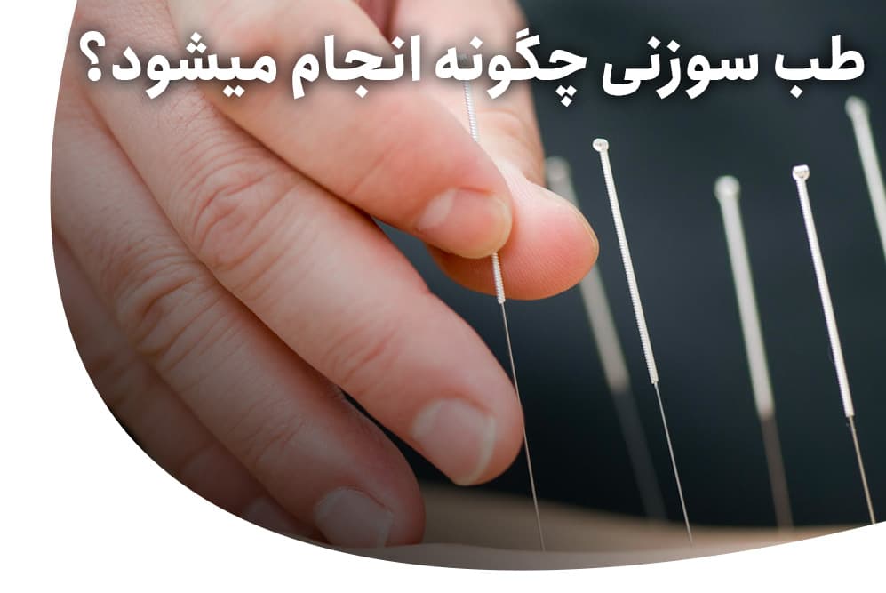 طب سوزنی چگونه انجام می‌شود؟