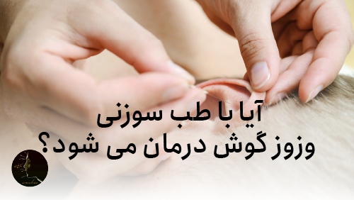 آیا با طب سوزنی وز وز گوش درمان میشود؟
