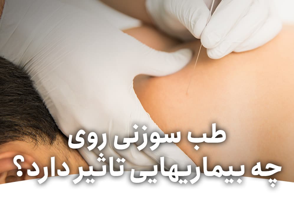 طب سوزنی روی چه بیماریهایی تاثیر دارد؟